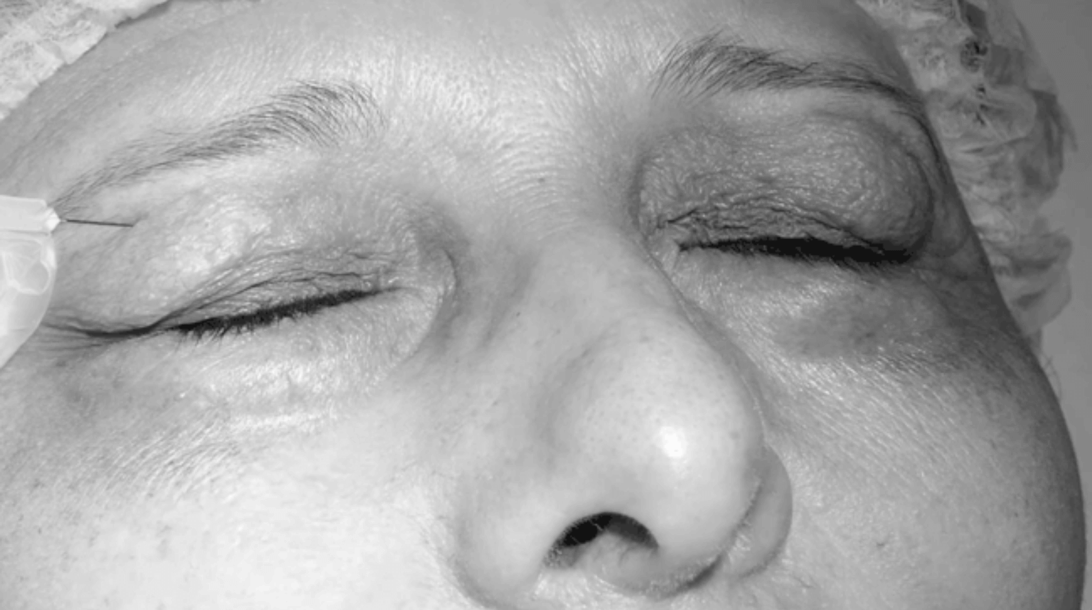 carboxy under eye treatment