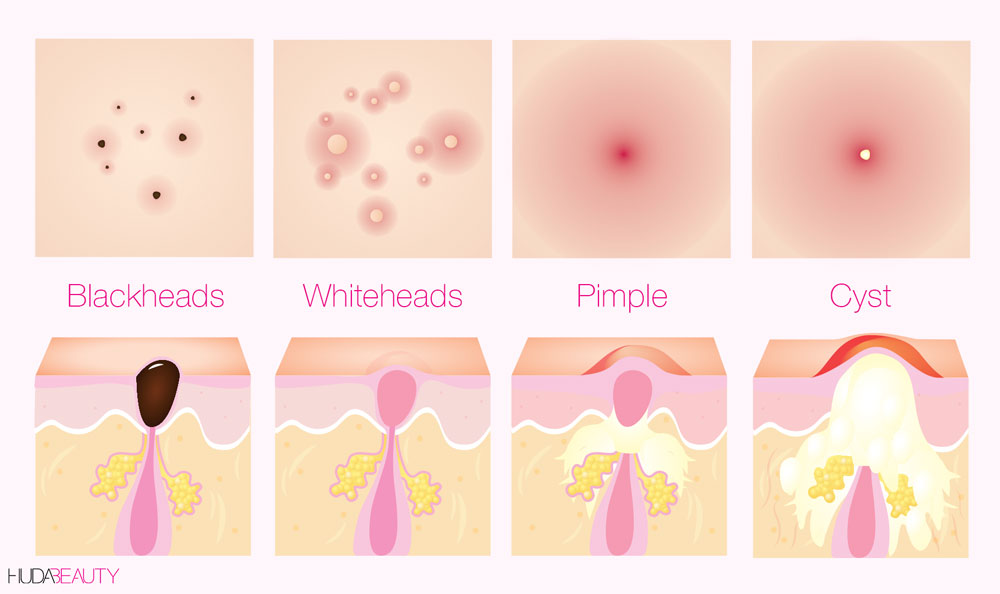 acne diagram