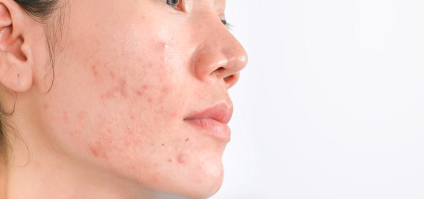 Hyperpigmentation