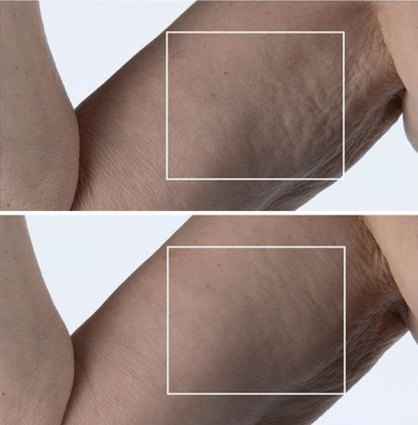 get rid of cellulite