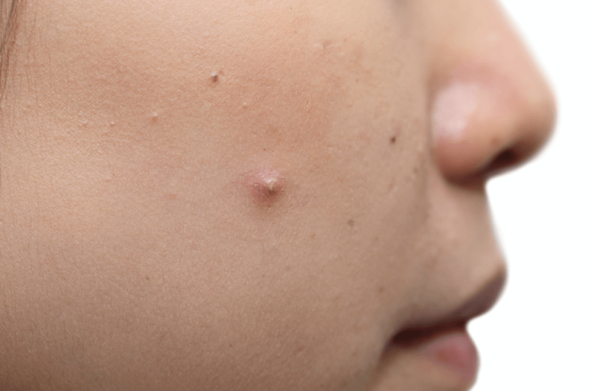 Closed Comedones White Bumps On Face Not Milia Acne Wikipedia Closed Comedones White Bumps On Face Not Milia Acne Wikipedia