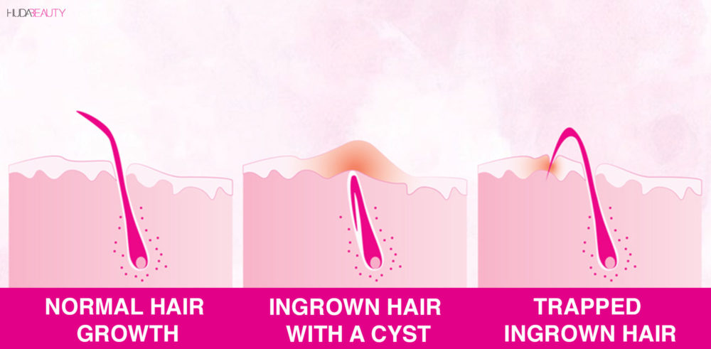 How to get online out ingrown hair