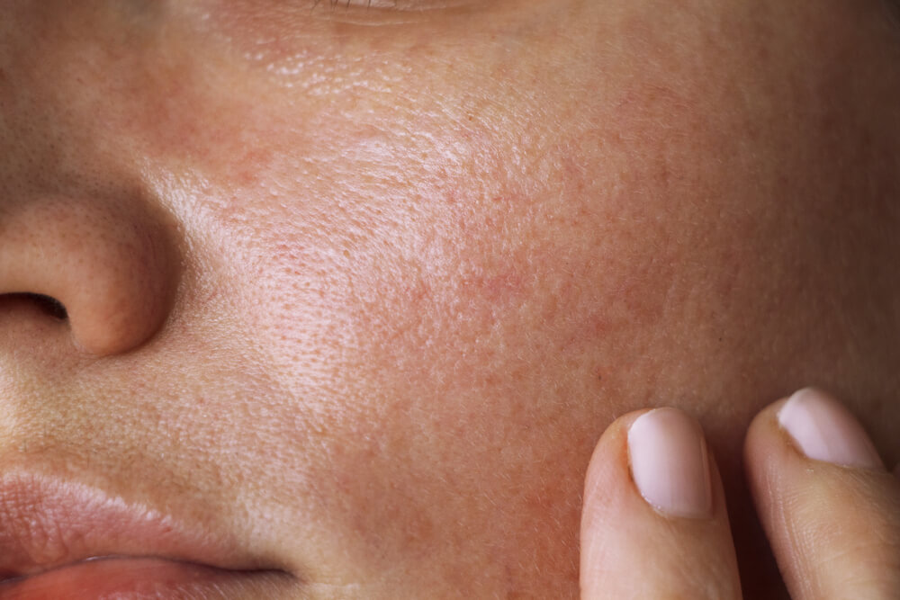 STRONGEST LASER TREATMENT FOR ACNE SCARS IS ROHRER AESTHETICS