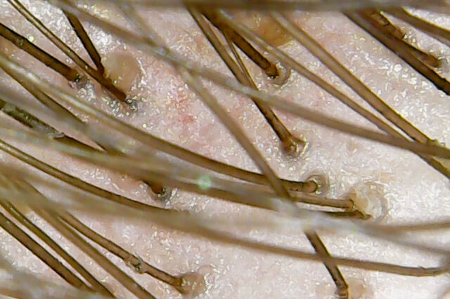 hair strand under microscope