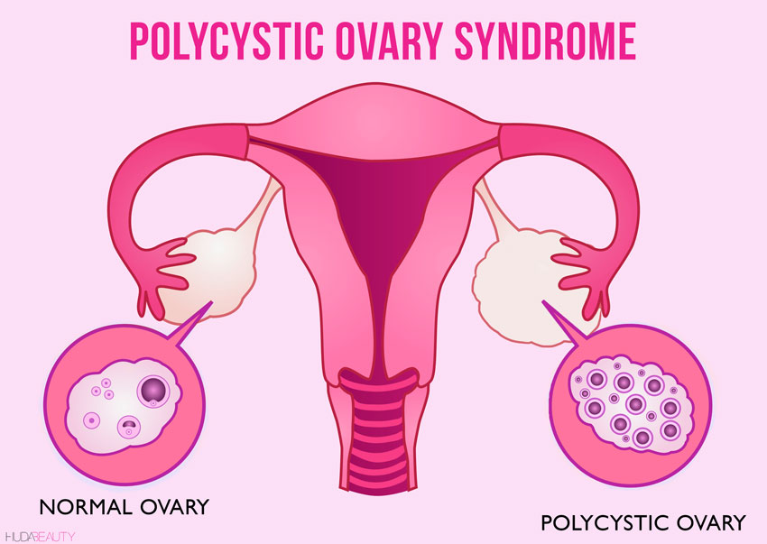 Everything You Need To Know About Polycystic Ovaries Blog Huda Beauty 9637