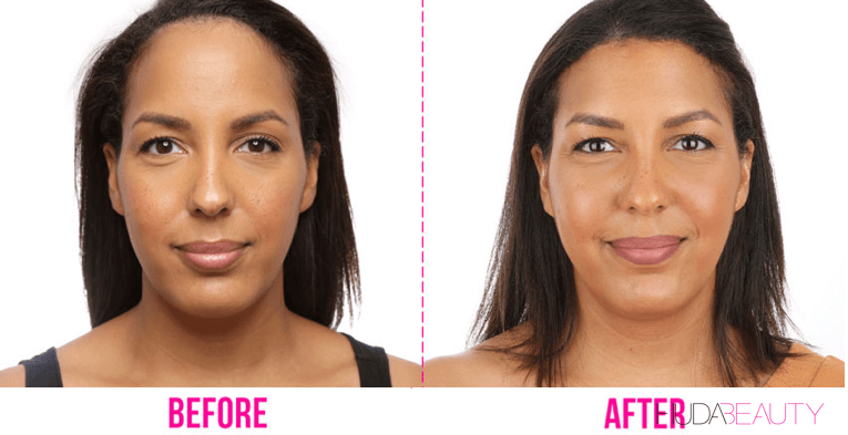 Forehead Reduction Surgery Is A Thing - We Did It!