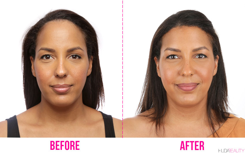 Forehead Reduction Surgery Is A Thing We Did It Blog Huda Beauty