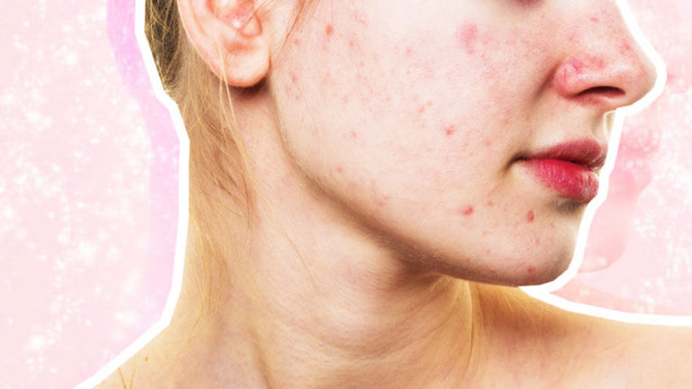 Derms Say These are the Biggest Acne Misconceptions