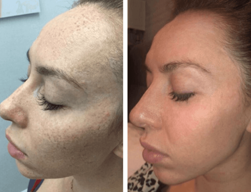 fraxel laser before and after
