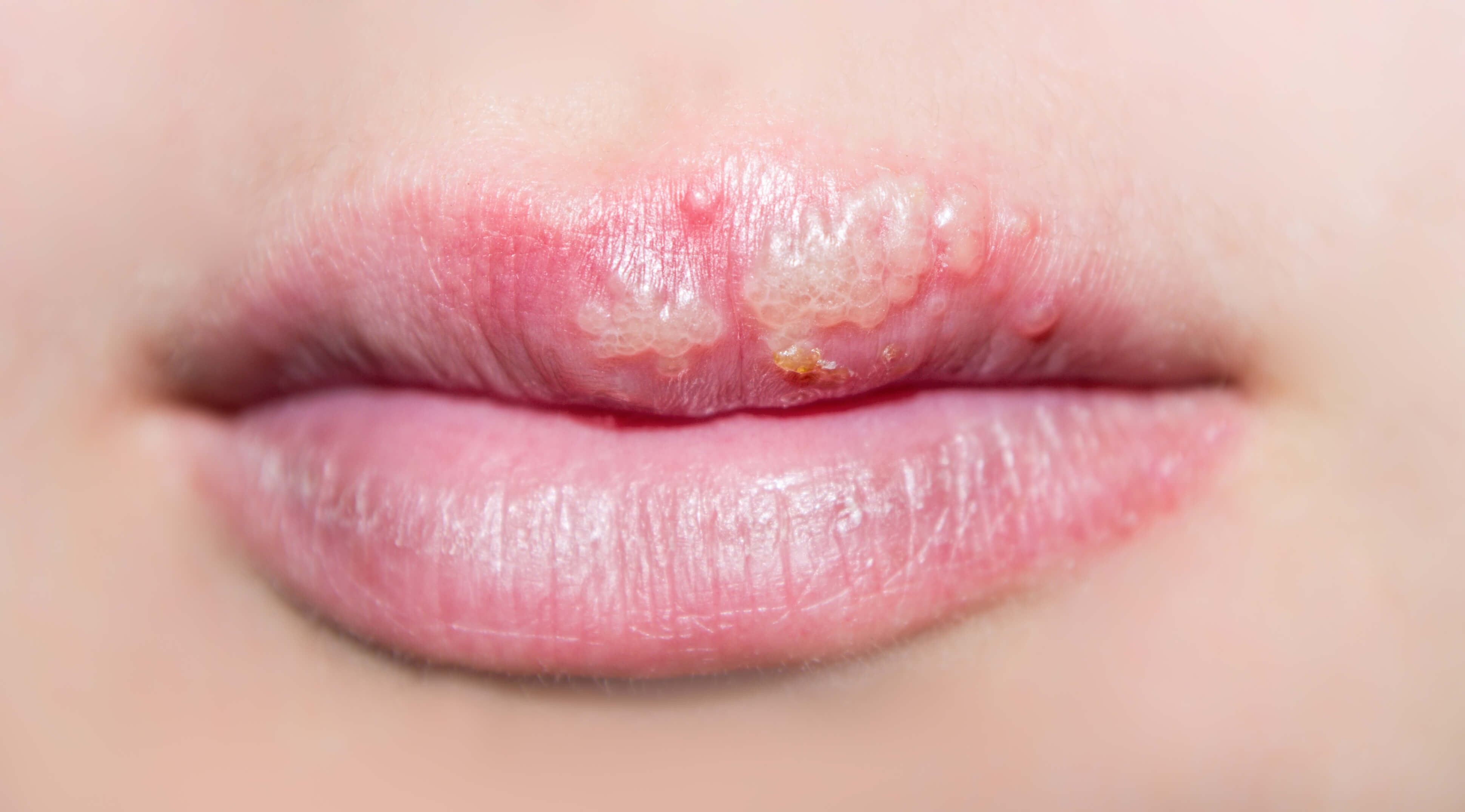 How To Get Rid Of A Cold Sore In 3 Days Flat Blog Huda Beauty