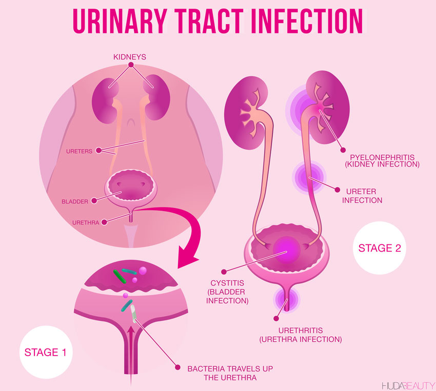 Urinary Tract Infections (UTIs) - Capital Women's Care