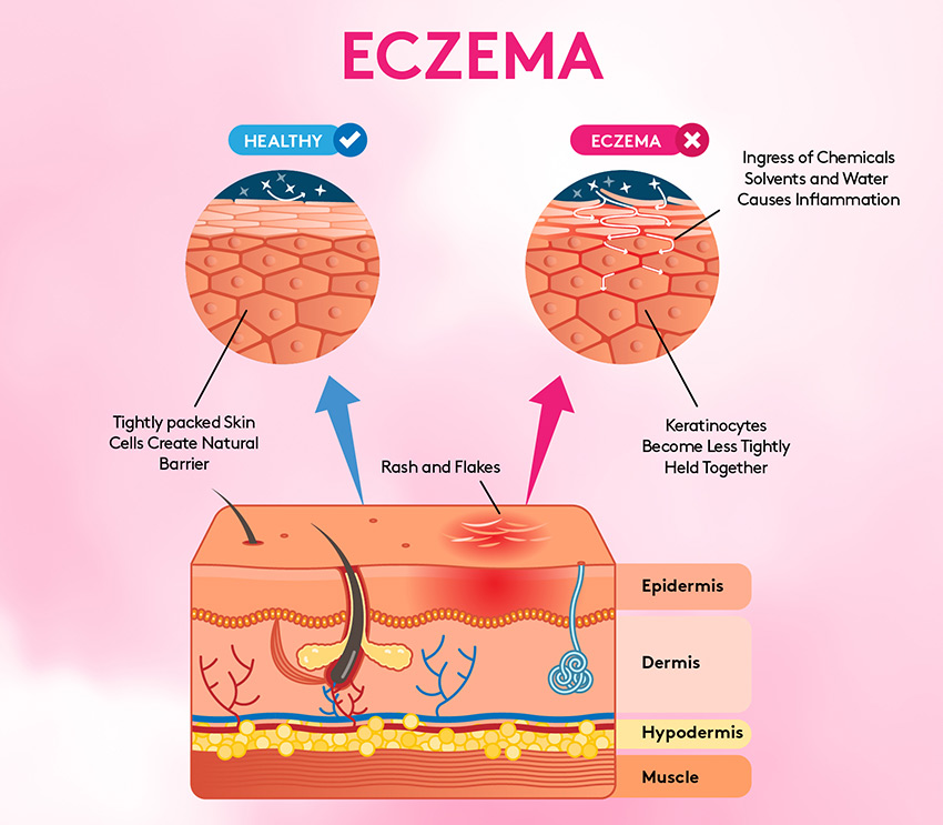How Does Tslp Cause Eczema Protein Linked To Atopic Dermatitis ENBS How Does Tslp Cause Eczema Protein Linked To Atopic Dermatitis ENBS