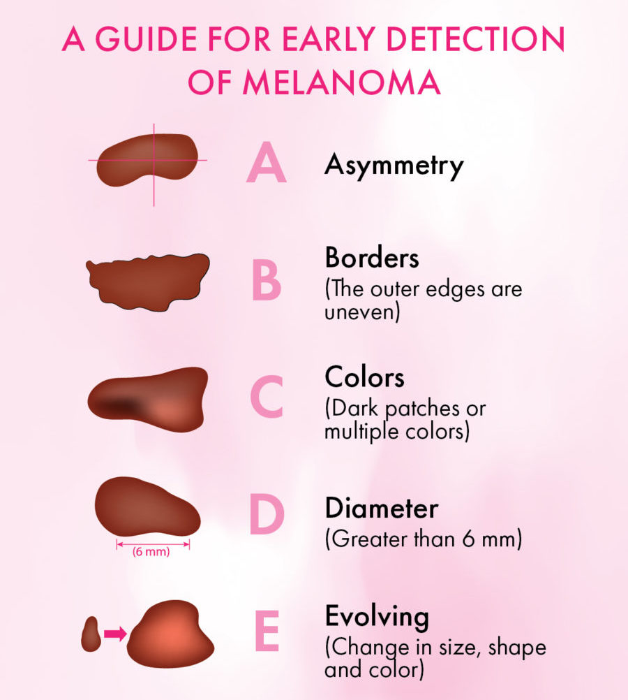 Guide-to-Detecting-Melanoma