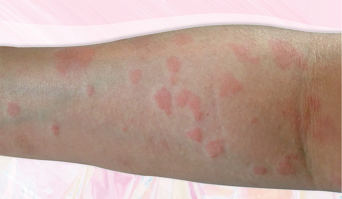 How Lupus Affects Your Skin And Body Plus How To Manage It Blog   Image 1 Lupus 