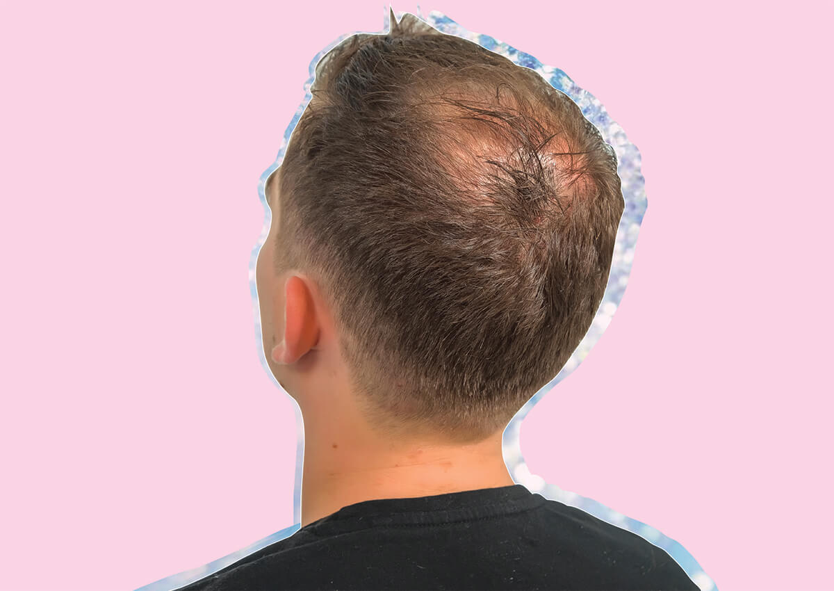 Male Pattern Baldness: Causes, Prevention & The Best Treatments