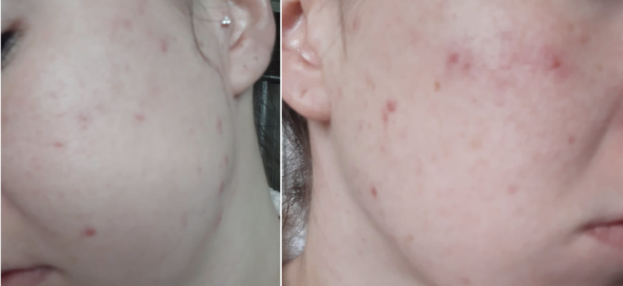 Before and after PRP Treatment