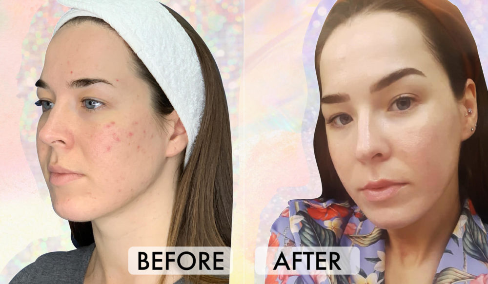 prp-mesotherapy-the-vampire-facial-what-it-is-how-it-works-2023