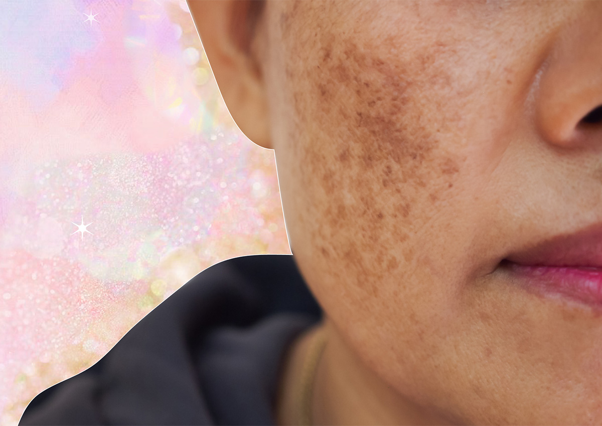 If You’ve Ever Dealt With Melasma, You Should Read This