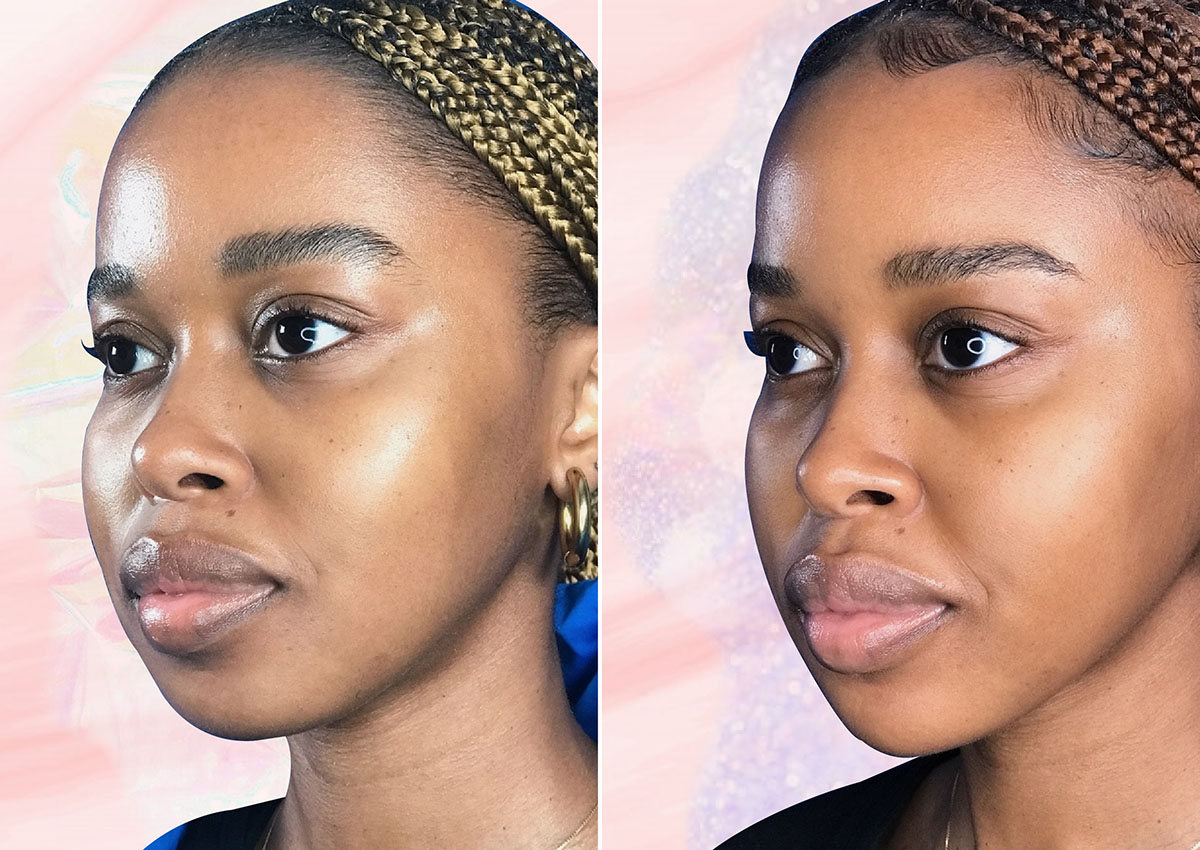 HB Team Tries: I Got Dermal Fillers In The Last Year Of My 20s & It Was My Best Purchase Yet