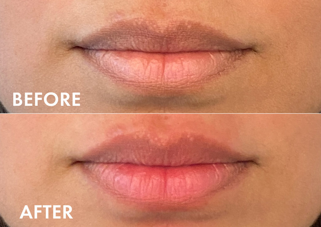 HBTries Can This TikTokTrending Lip Plumper Replace Lip Fillers