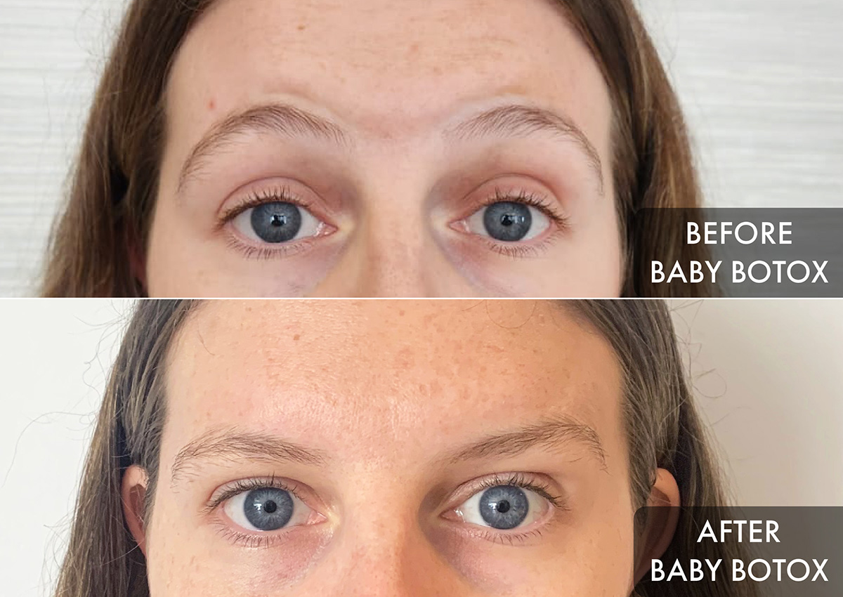baby botox