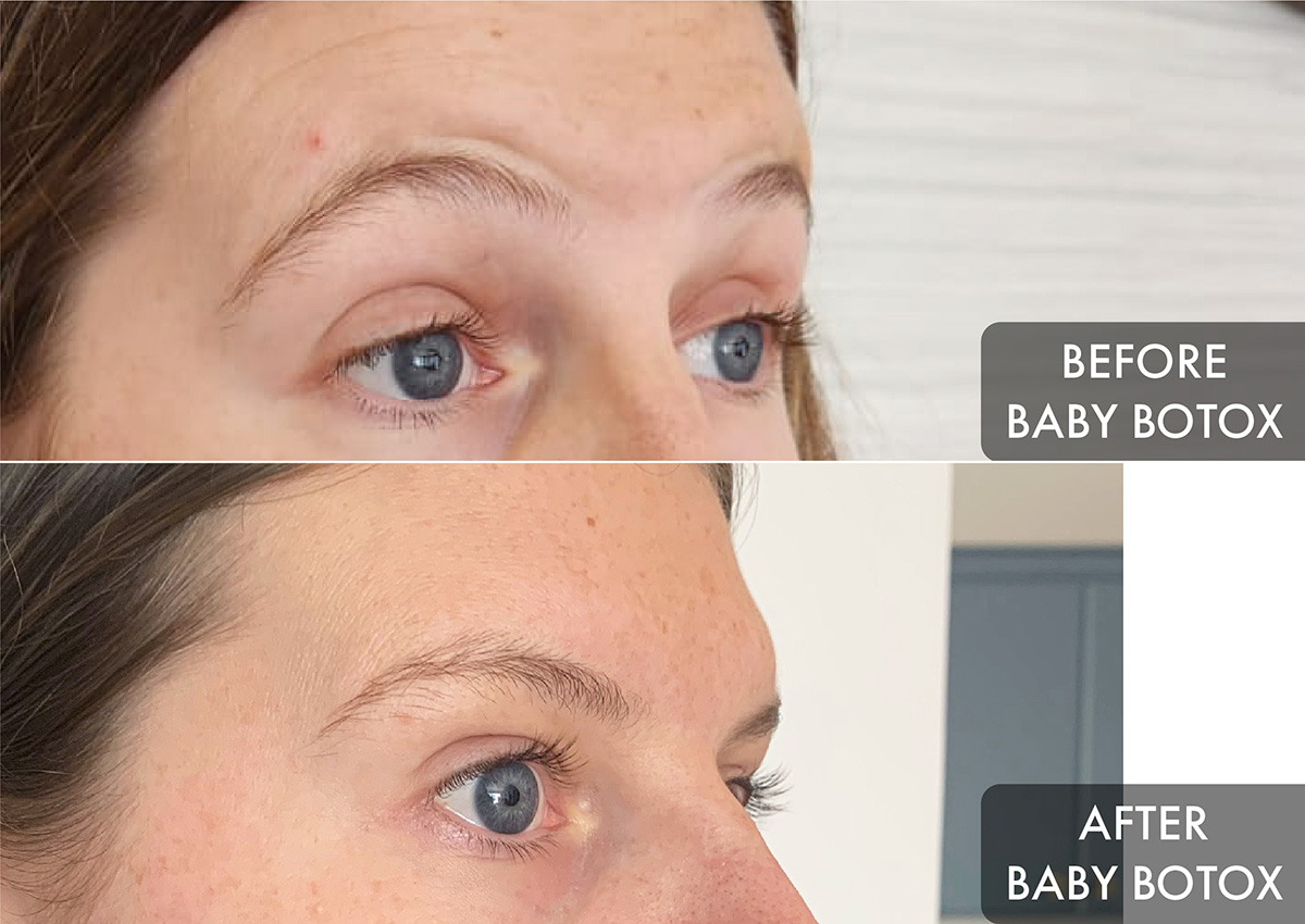 Not Sure When To Get Botox? We Tried Baby Botox For The First Time